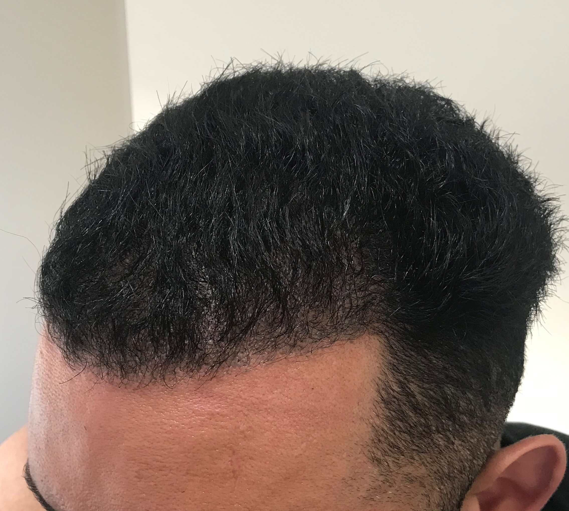 Afro hair transplant Westminster clinic