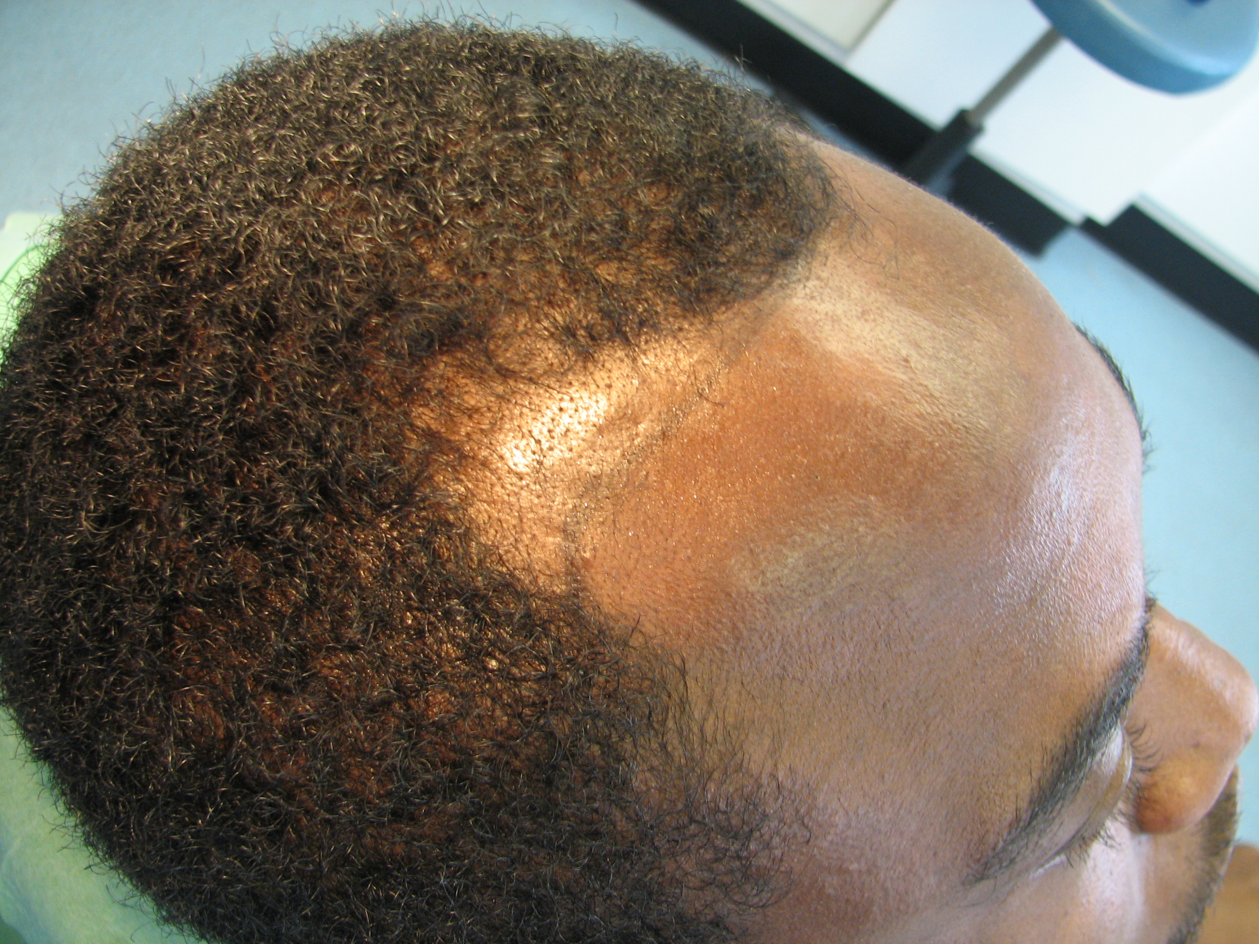Afro hair transplant Westminster clinic
