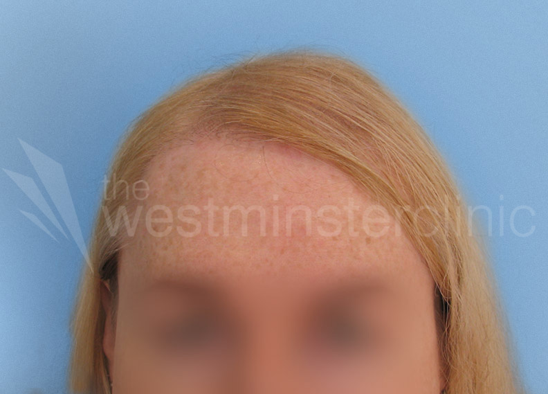 transgender hair restoration illinois support for gay marriage