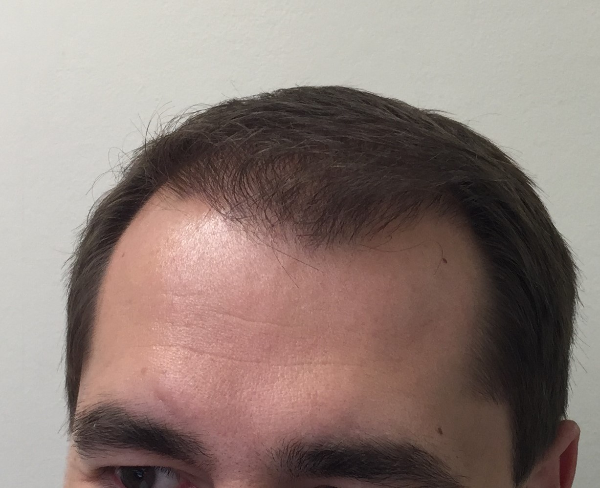 Propecia 9 months