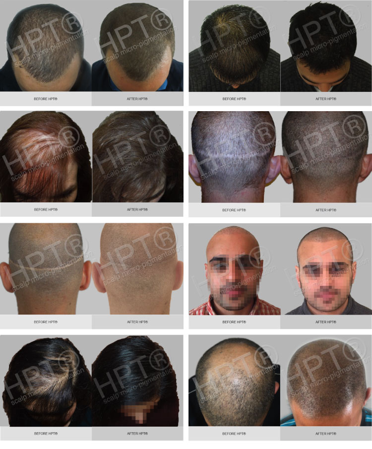 scalp-micropigmentation-img