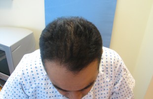 Asian Hair Transplant