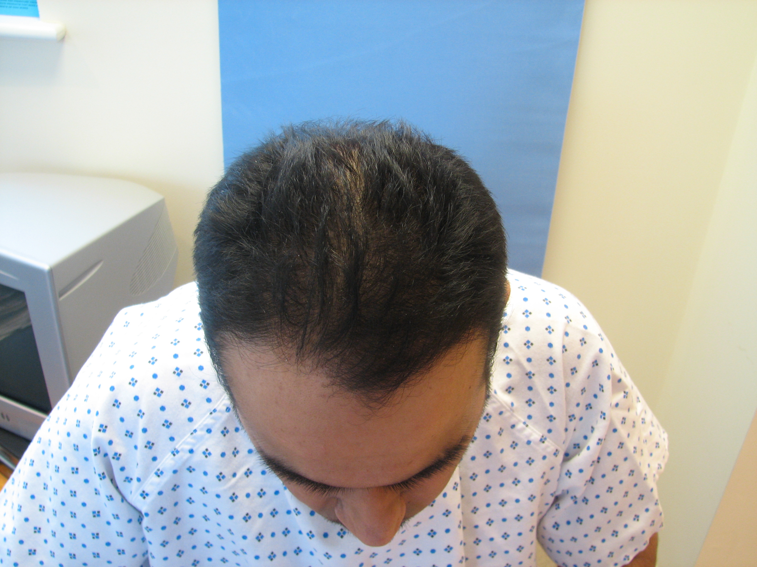 34 HQ Photos Asian Hair Transplant - This 33 Year Old Asian Female Is Shown Before And 10 Months After A Female Hairline Lowering To Improv Hair Transplant Women Frontal Hairstyles Hair Transplant