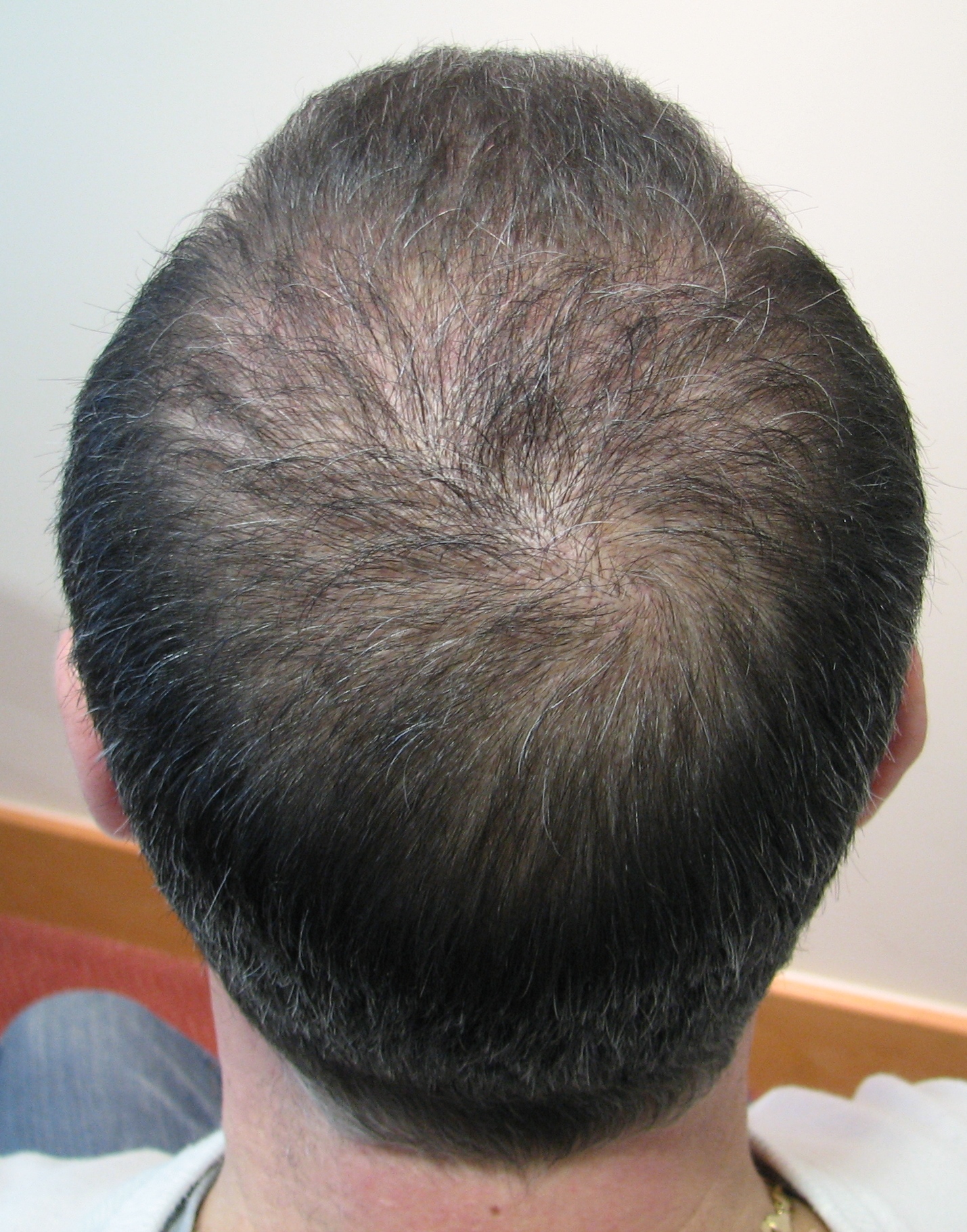 Crown hair transplant