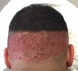 Afro hair transplant black male patient