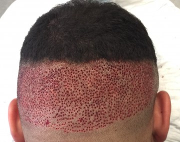 Afro hair transplant black male patient