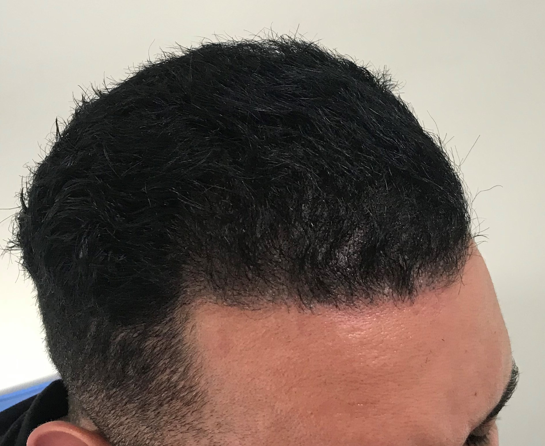 Afro hair transplant Westminster clinic Afro hair transplant Westminster clinic