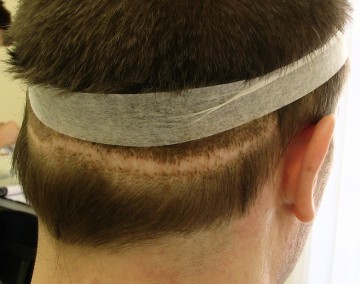 hair transplant scar repair