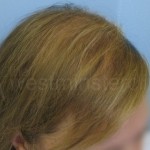 female hair transplants, female hair transplant, transplant women hair loss