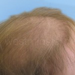 female hair transplant, female hair transplants, hair transplants in women