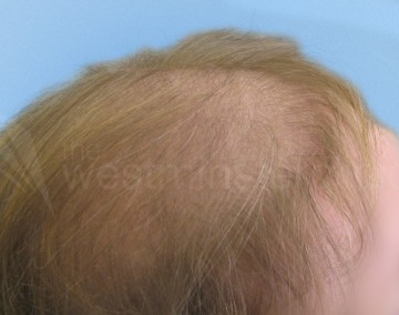 female hair transplant, female hair transplants, hair transplants in women