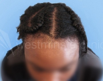Afro Hair Transplant Westminster Clinic