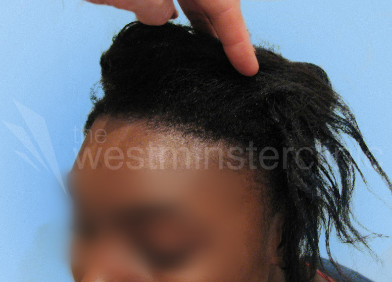 Afro hair transplant Westminster clinic Afro hair transplant Westminster clinic