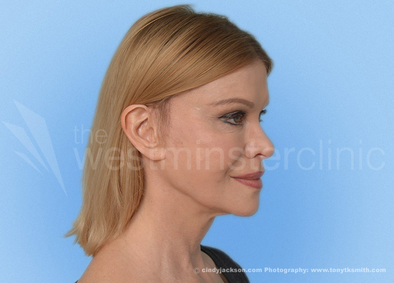 sideburns hair transplant