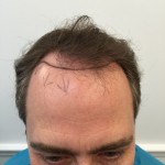 Dr Rogers hairline transplant