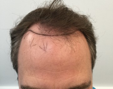 Dr Rogers hairline transplant