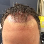 hair transplant incisions