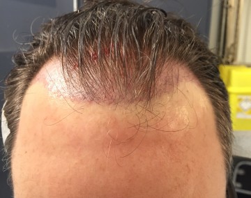 hair transplant incisions