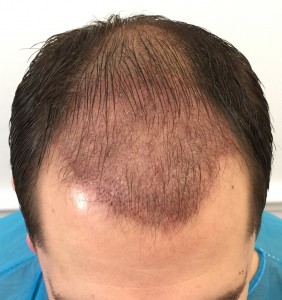 before hair transplant