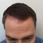 Dr Rogers after hair transplant
