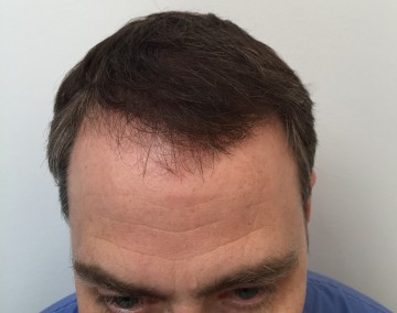 Dr Rogers after hair transplant