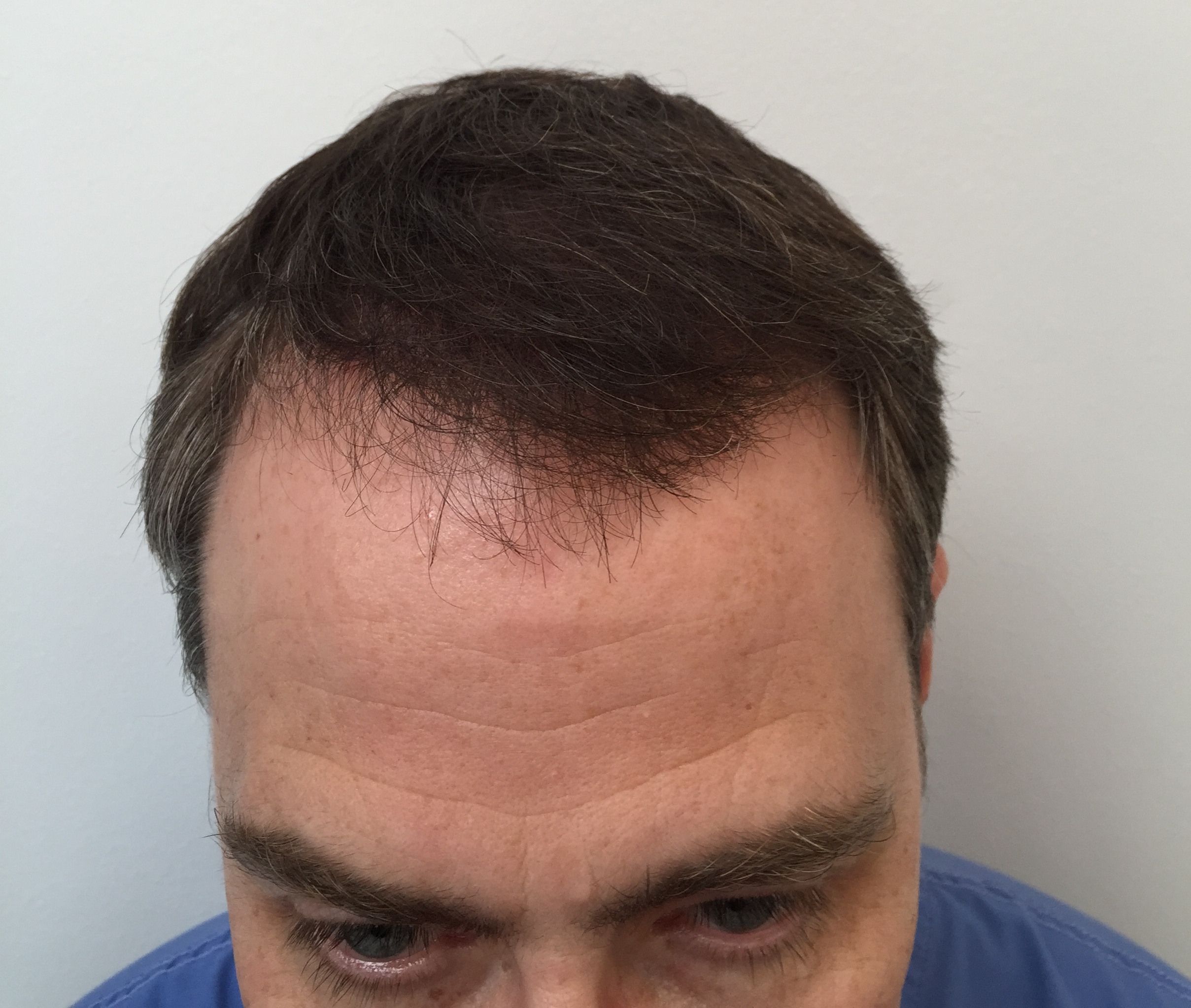 Hair transplant procedure 