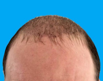 Norwood 6 bald, 2500 FUT grafts