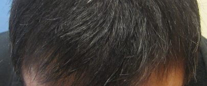 Asian male hair transplant