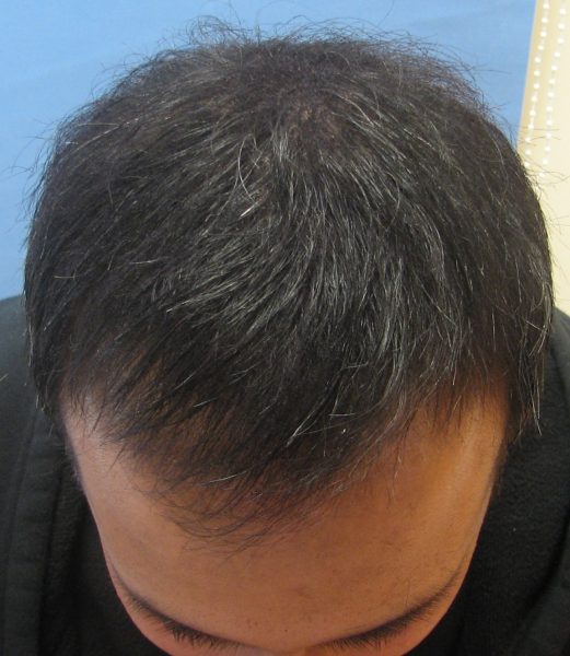 Asian male hair transplant