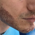 Bear hair transplant after