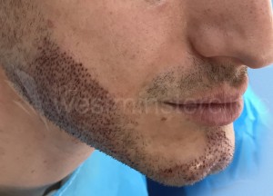 Bear hair transplant after