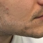 Beard hair transplant