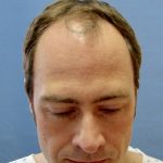 Dr Rogers before his FUT hair transplant