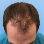 Before hair transplant 2000 strip grafts