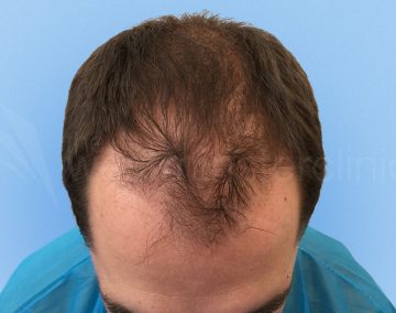 Before hair transplant 2000 strip grafts