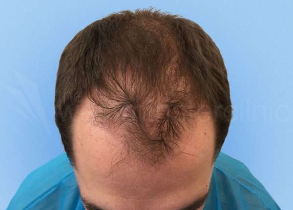 Before hair transplant 2000 strip grafts
