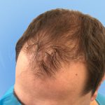 Before hair transplant 2000 strip grafts