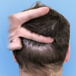 hair transplant 2000 strip grafts