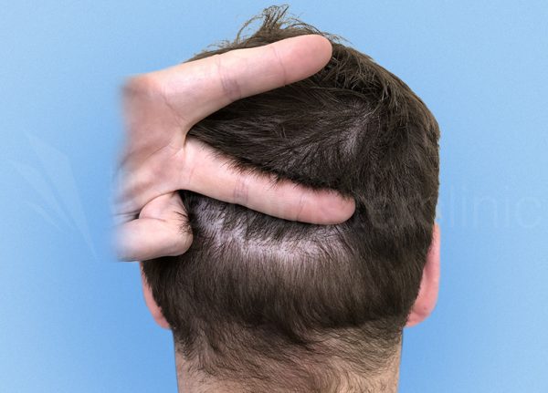 Invisible strip (FUT) hair transplant scar