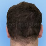 hair transplant 2000 strip grafts