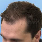 hair transplant 2000 strip grafts