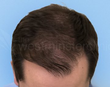 hair transplant 2000 strip grafts