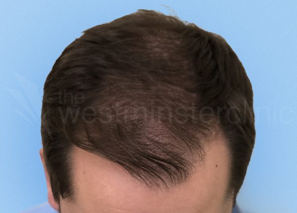hair transplant 2000 strip grafts