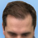 hair transplant 2000 strip grafts