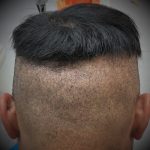 Shaved FUE
