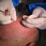 Shaved FUE with old punch