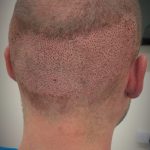 0.8mm FUE punch