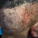 2 day FUE healing