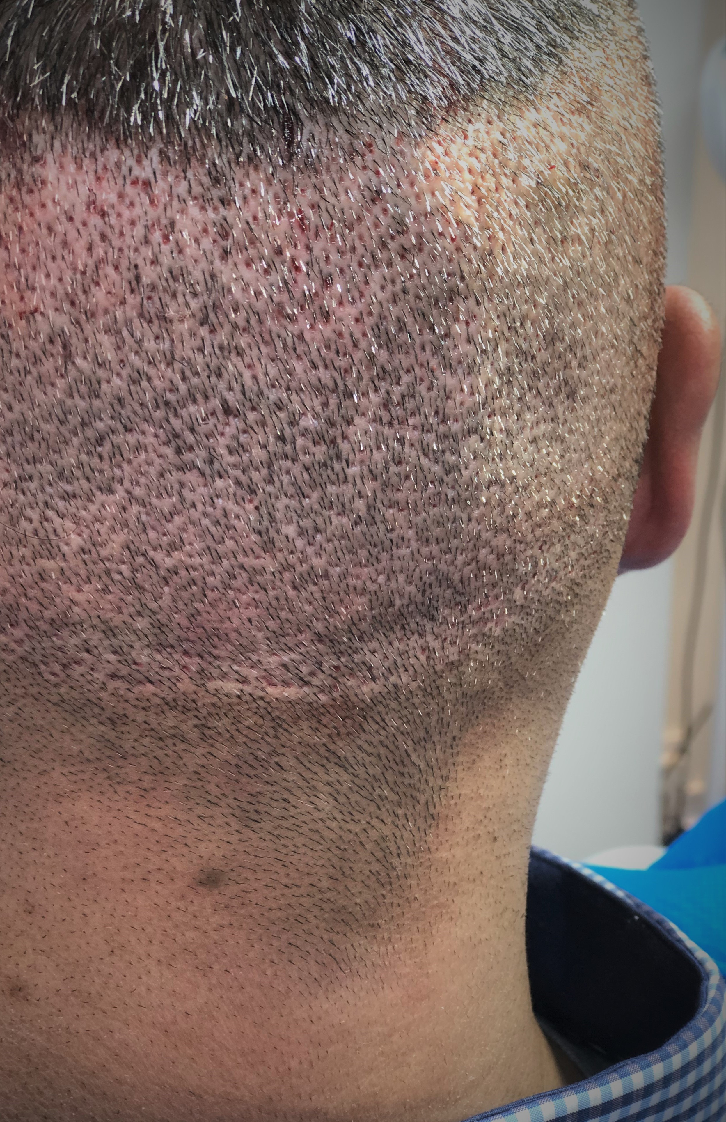 Scabs on Scalp: Everything You Need to Know - Wimpole Clinic