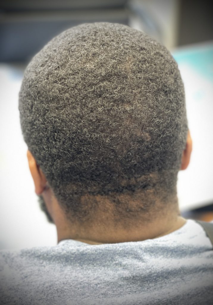 Afro FUE 2 months after donor area